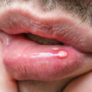 Home Remedies For Mouth Sores From Stress